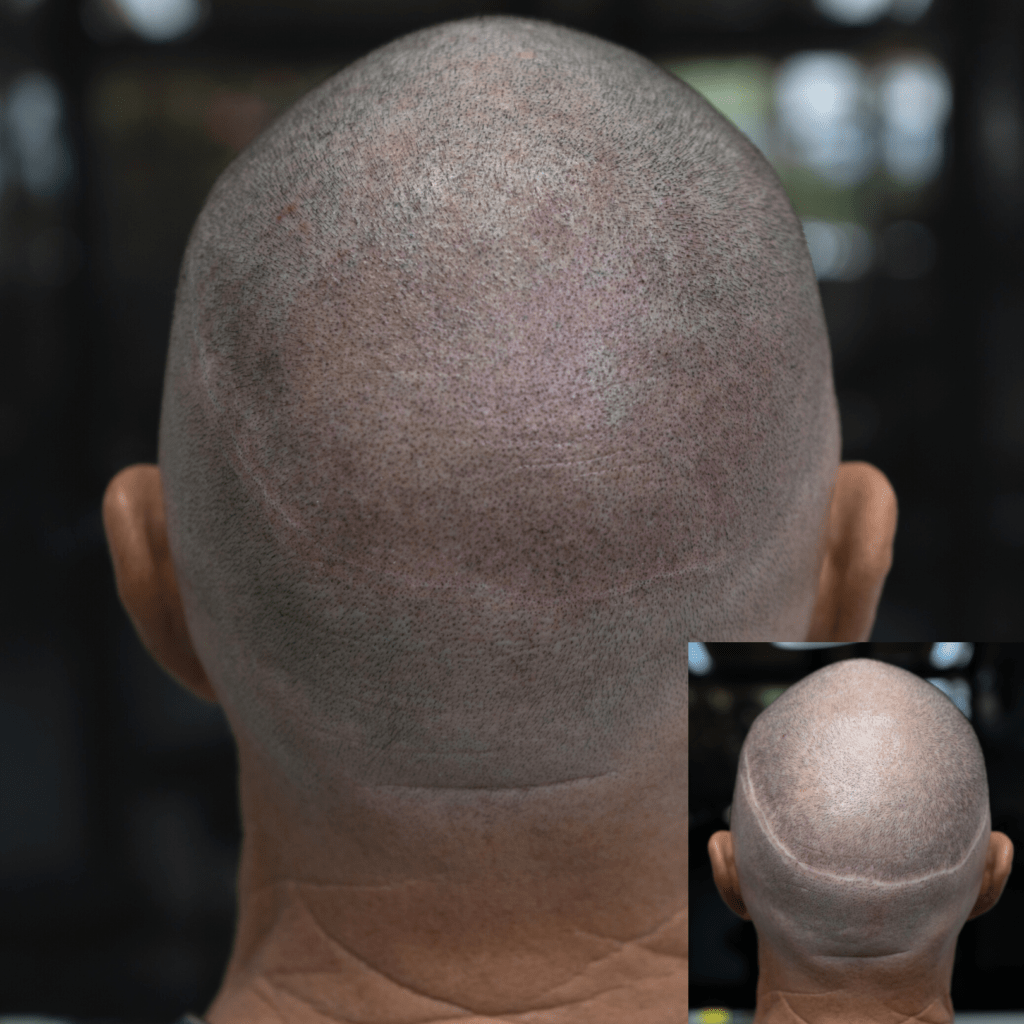 Scar Camouflage- AZ ScalpDoctor